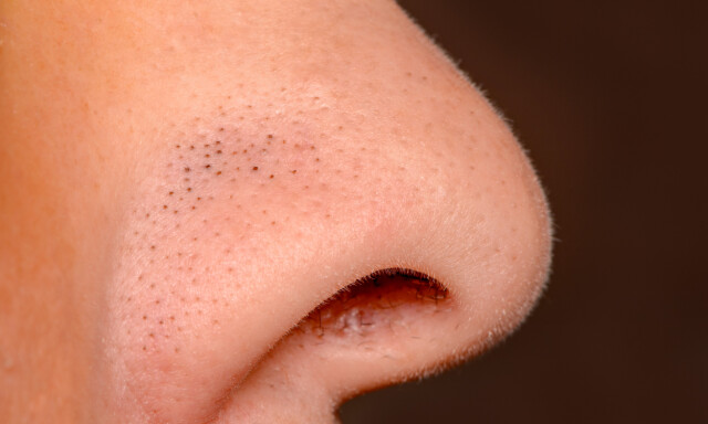 HUDORMER: Såkalte åpne komedoner. Svarte hudormer på nesen - forårsaket av tettpakkede hudceller, oksidering av talget og hudens fargestoff melanin. FOTO: NTB Scanpix / Shutterstock. HUDORMER: Såkalte åpne komedoner. Svarte hudormer på nesen - forårsaket av tettpakkede hudceller, oksidering av talget og hudens fargestoff melanin. FOTO: NTB Scanpix / Shutterstock.